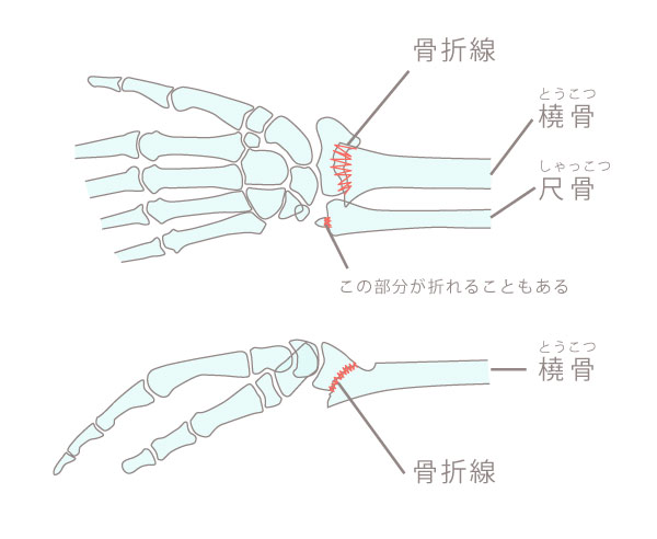 橈骨遠位端骨折骨レントゲン骨の状態